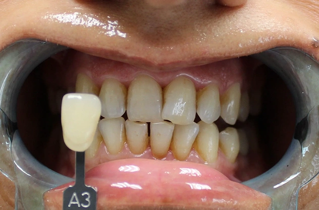 Teeth Cleaning in Troy